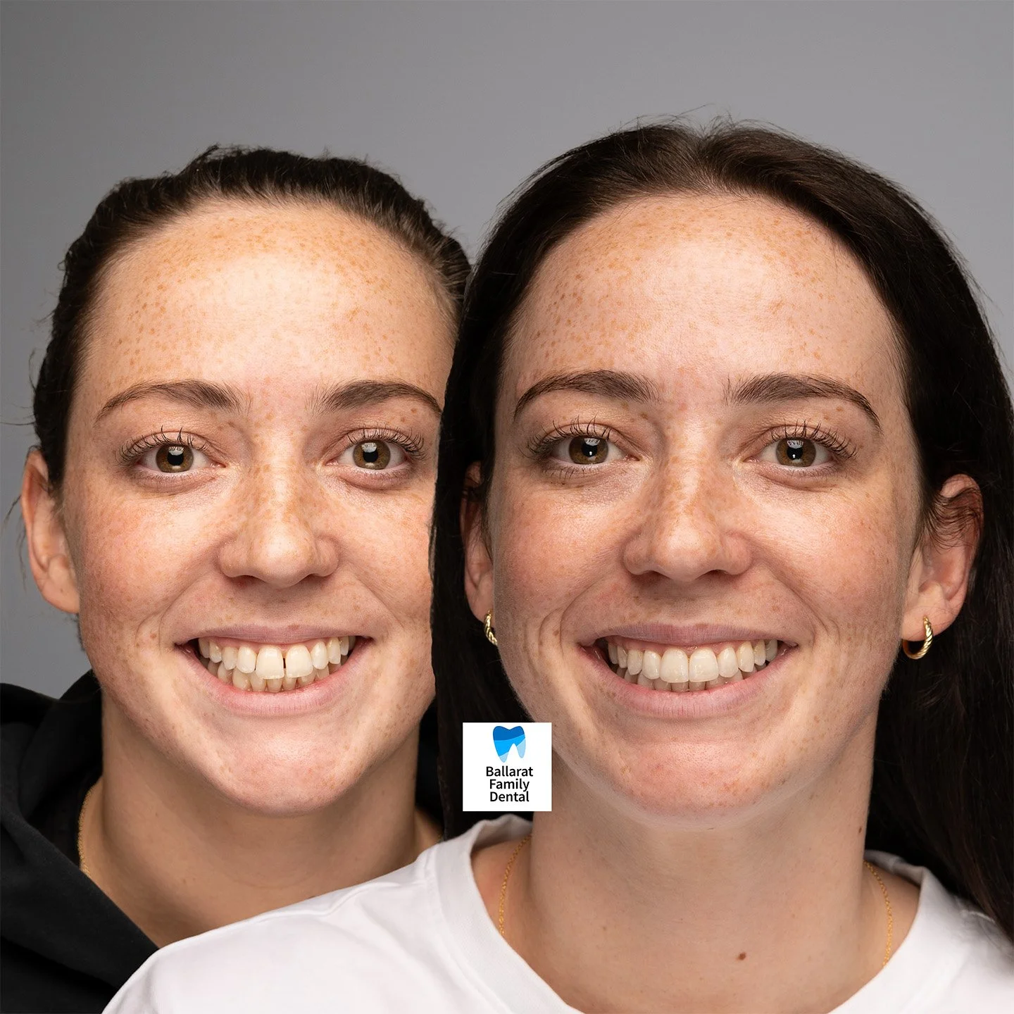 Treatment: Aligners