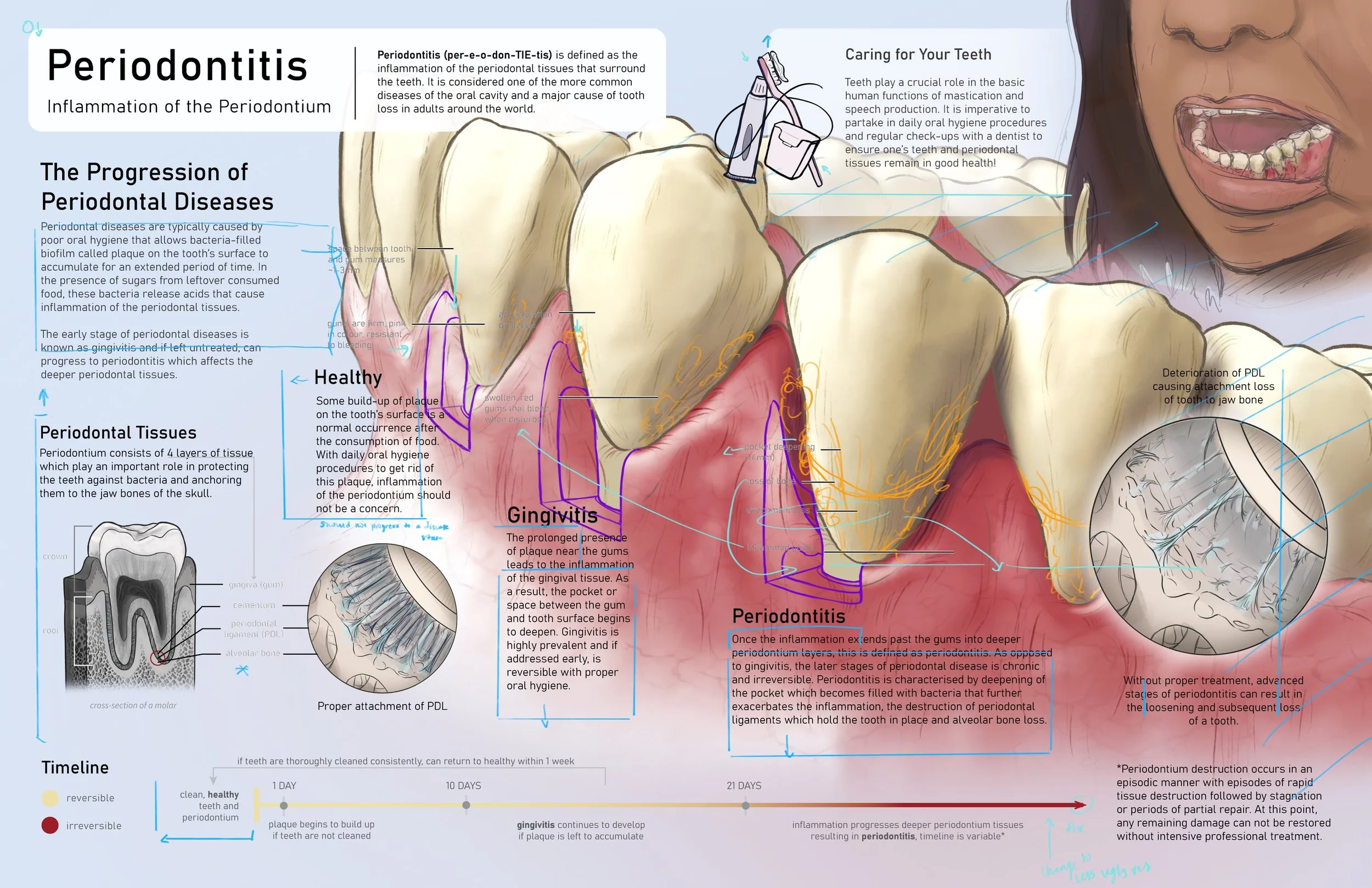 LN_periodontitis_C_planningCuts.jpg