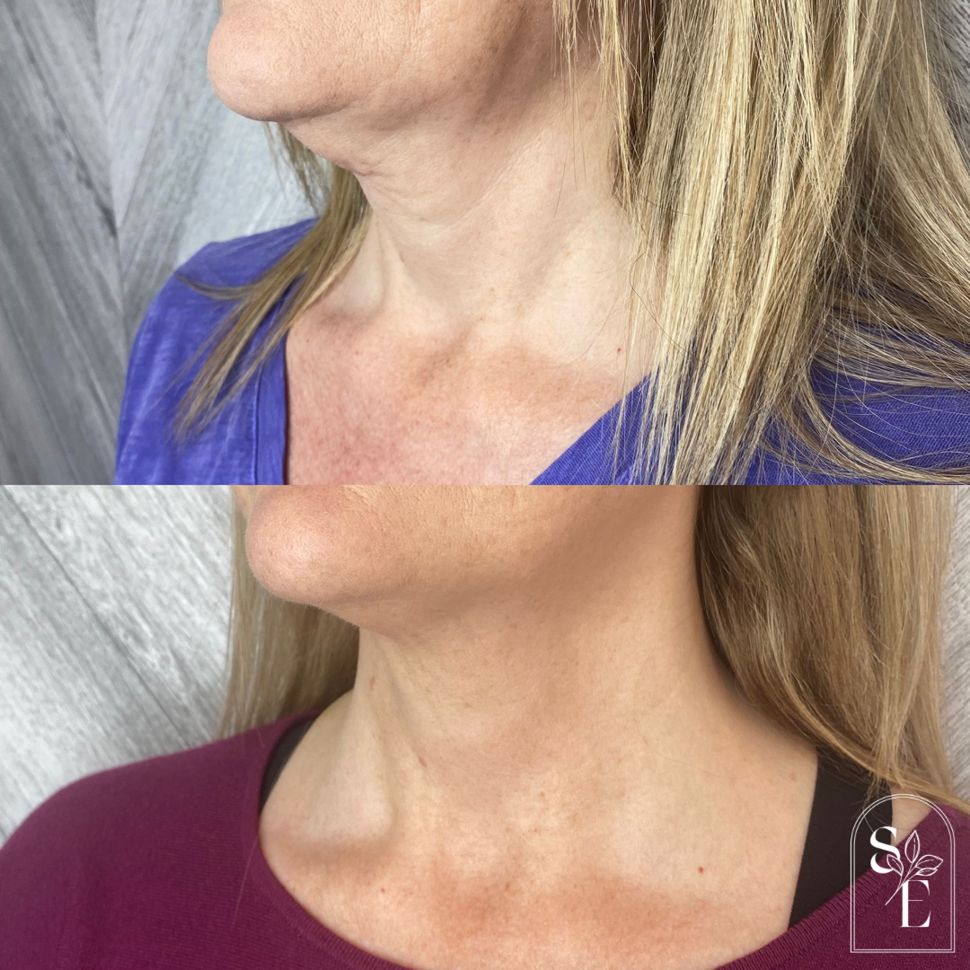 Radiesse Neck Rejuvenation