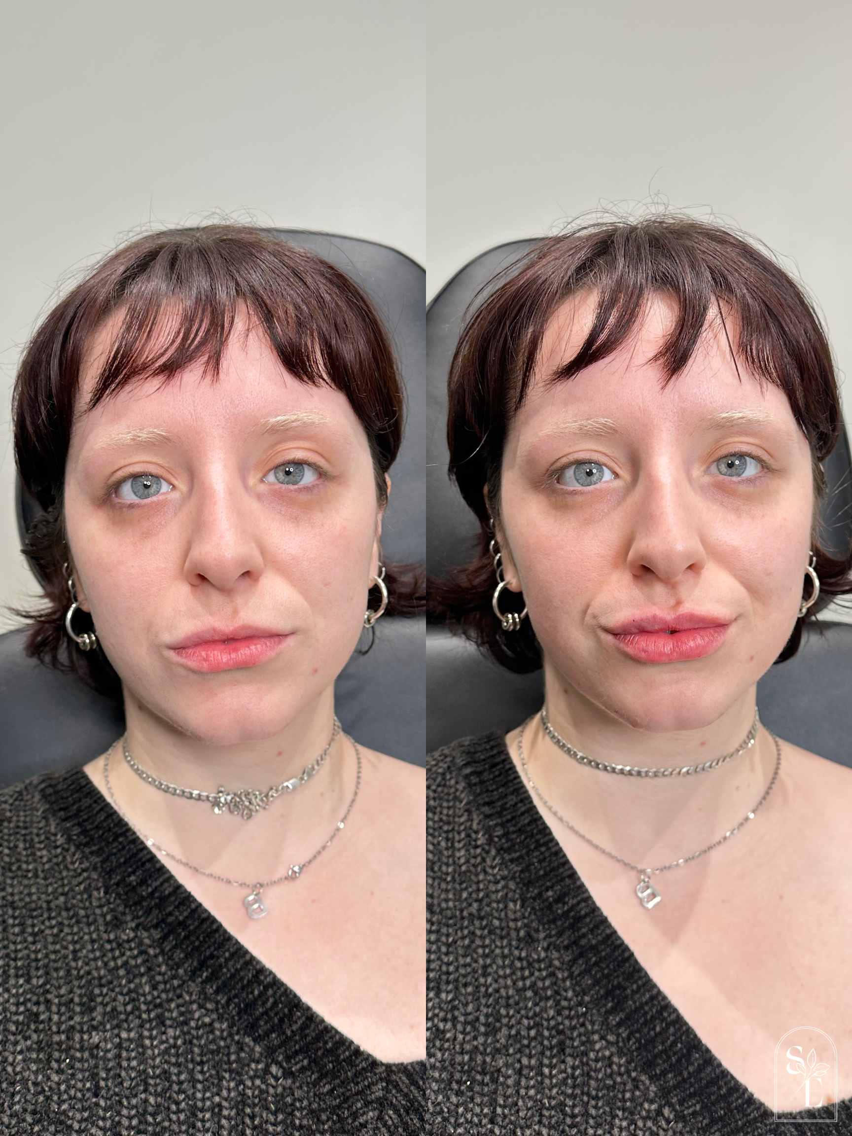 Lip Filler