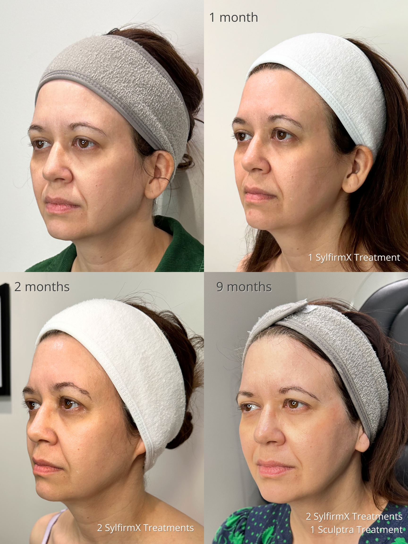 Sculptra + SylfirmX