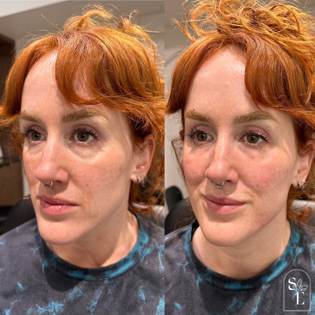  Upper Face Botox Dermal Filler: cheeks, lips &amp; under eye 