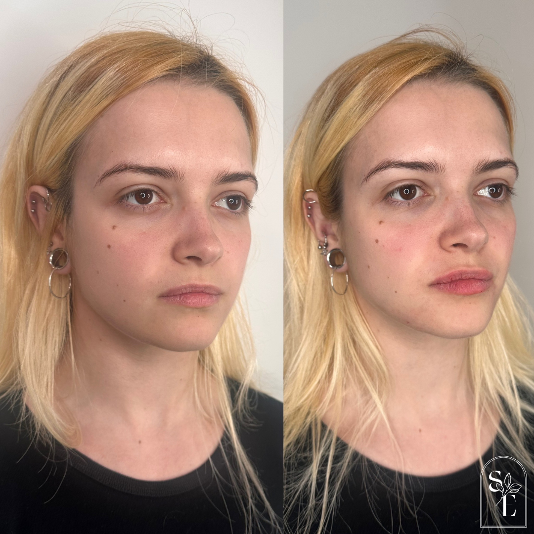  Upper Face Botox Dermal Filler: cheeks, chin, lips &amp; chin shadows 