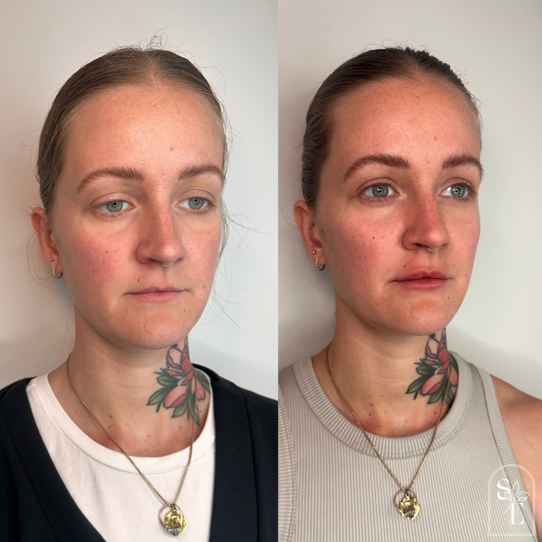  Full Face Botox Lower Face Sculptra Dermal Filler: cheeks, lips &amp; corners of mouth 