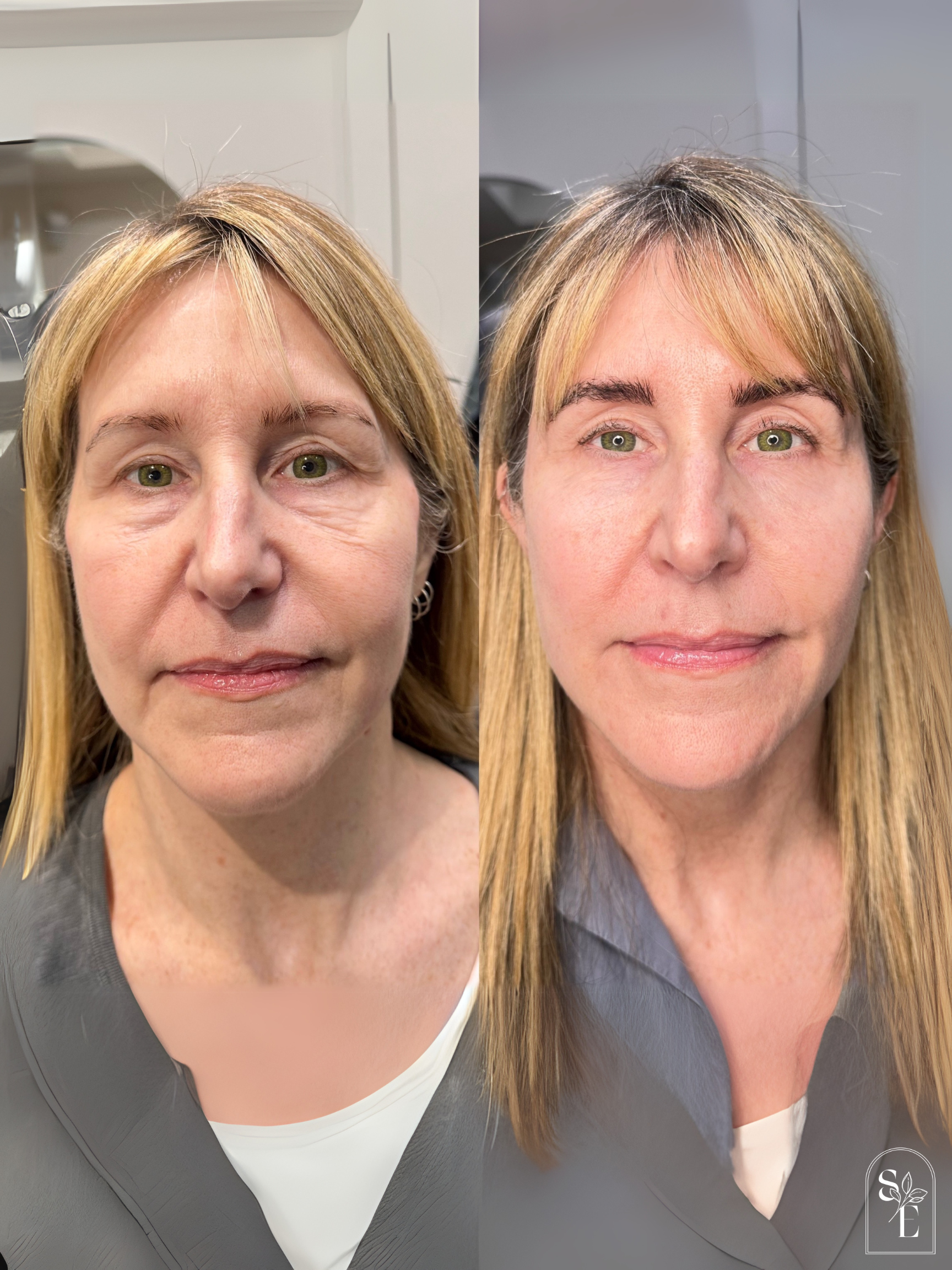  Upper Face Tox Dermal Filler: cheeks &amp; lips 