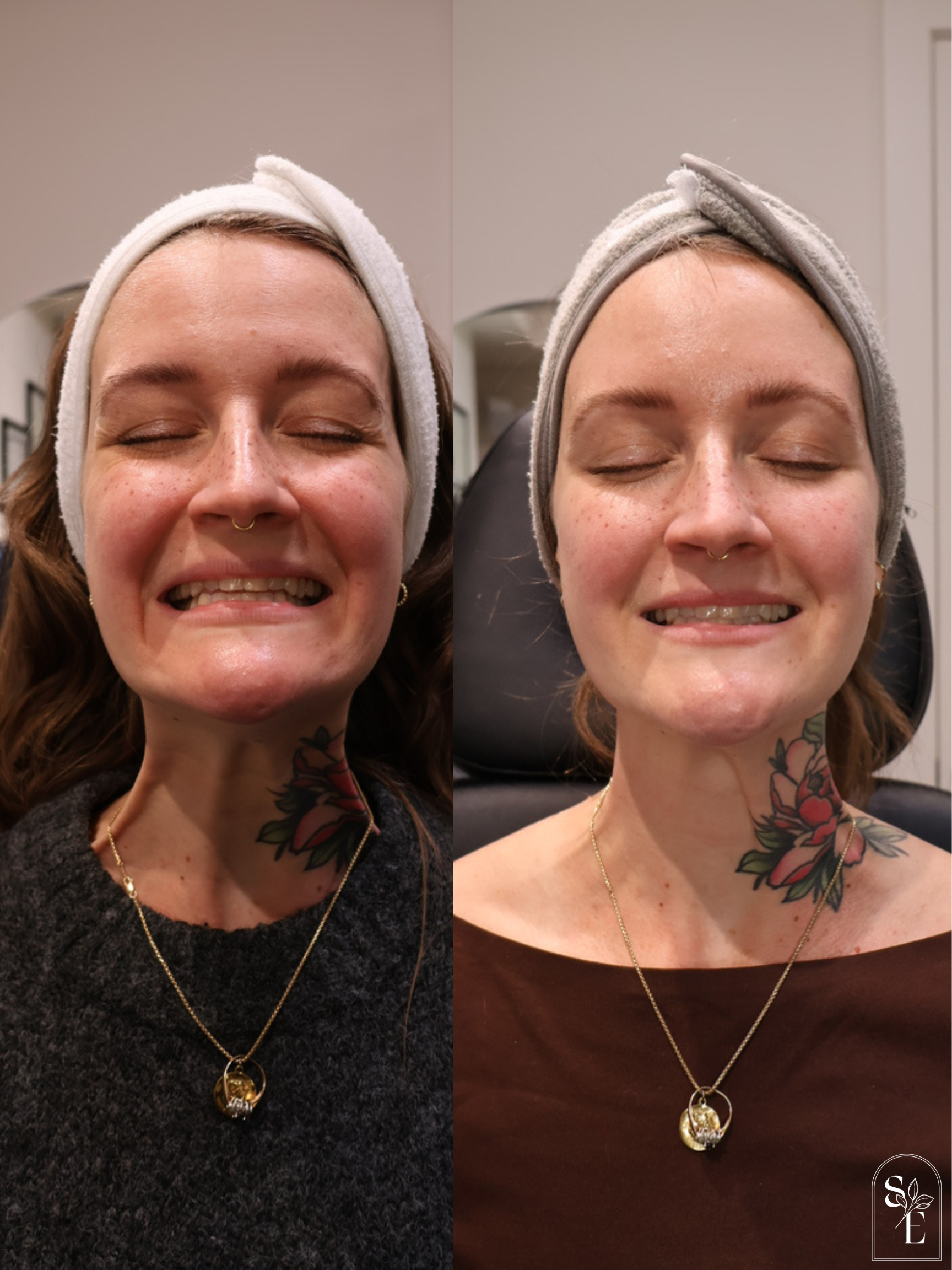 Neck Rejuvenation with Botox
