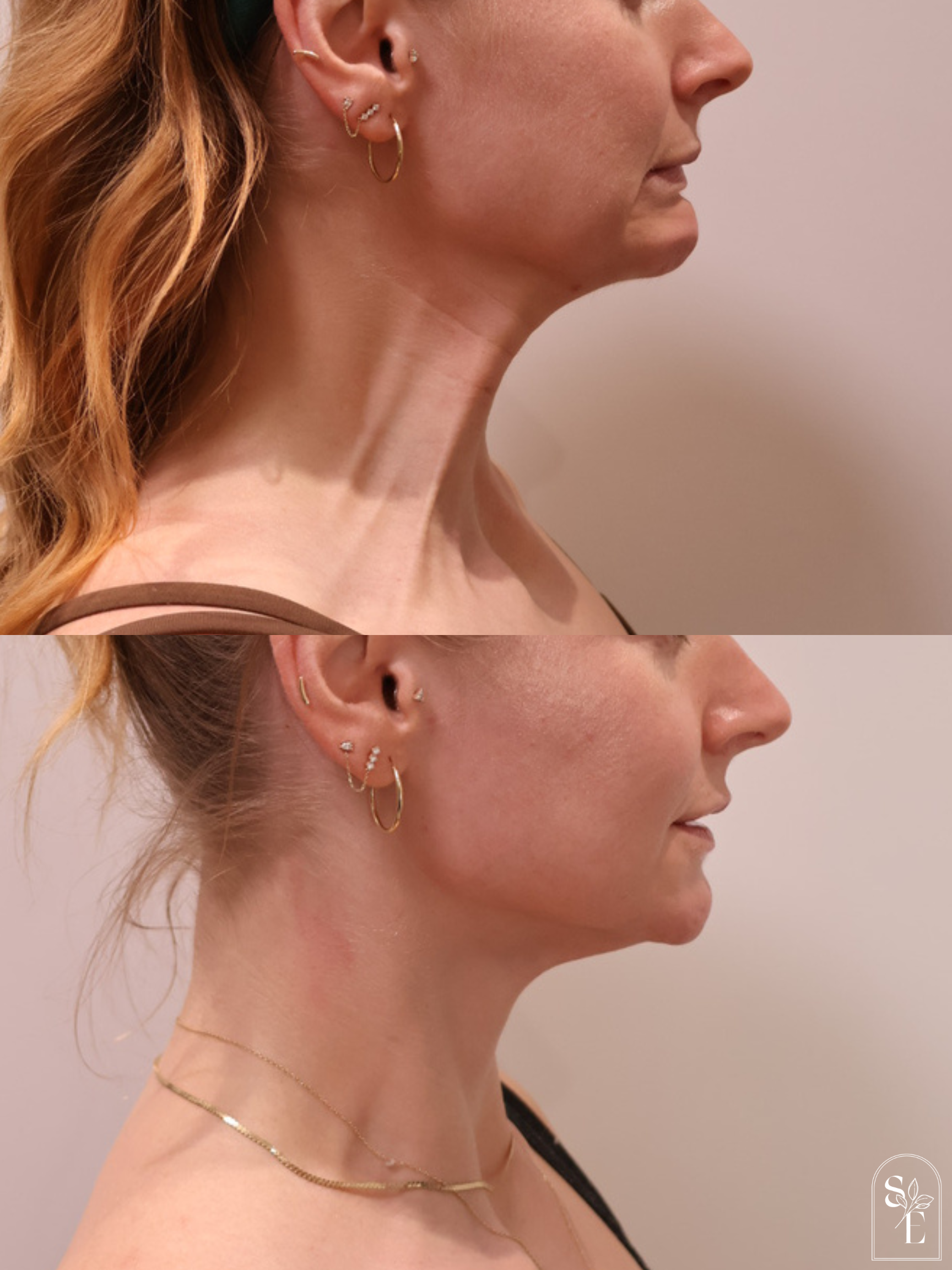 Neck Rejuvenation with Botox