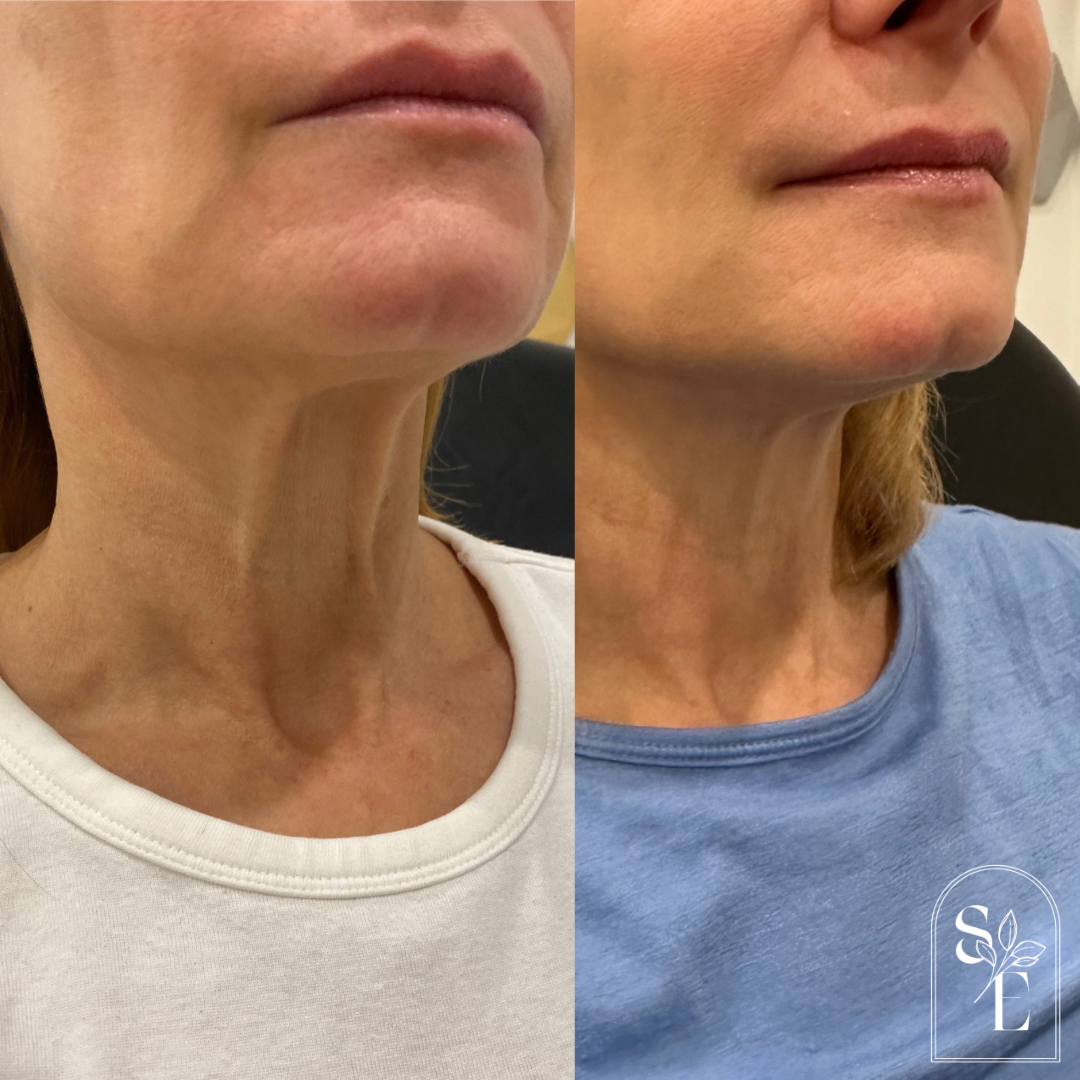 Neck Rejuvenation with Botox