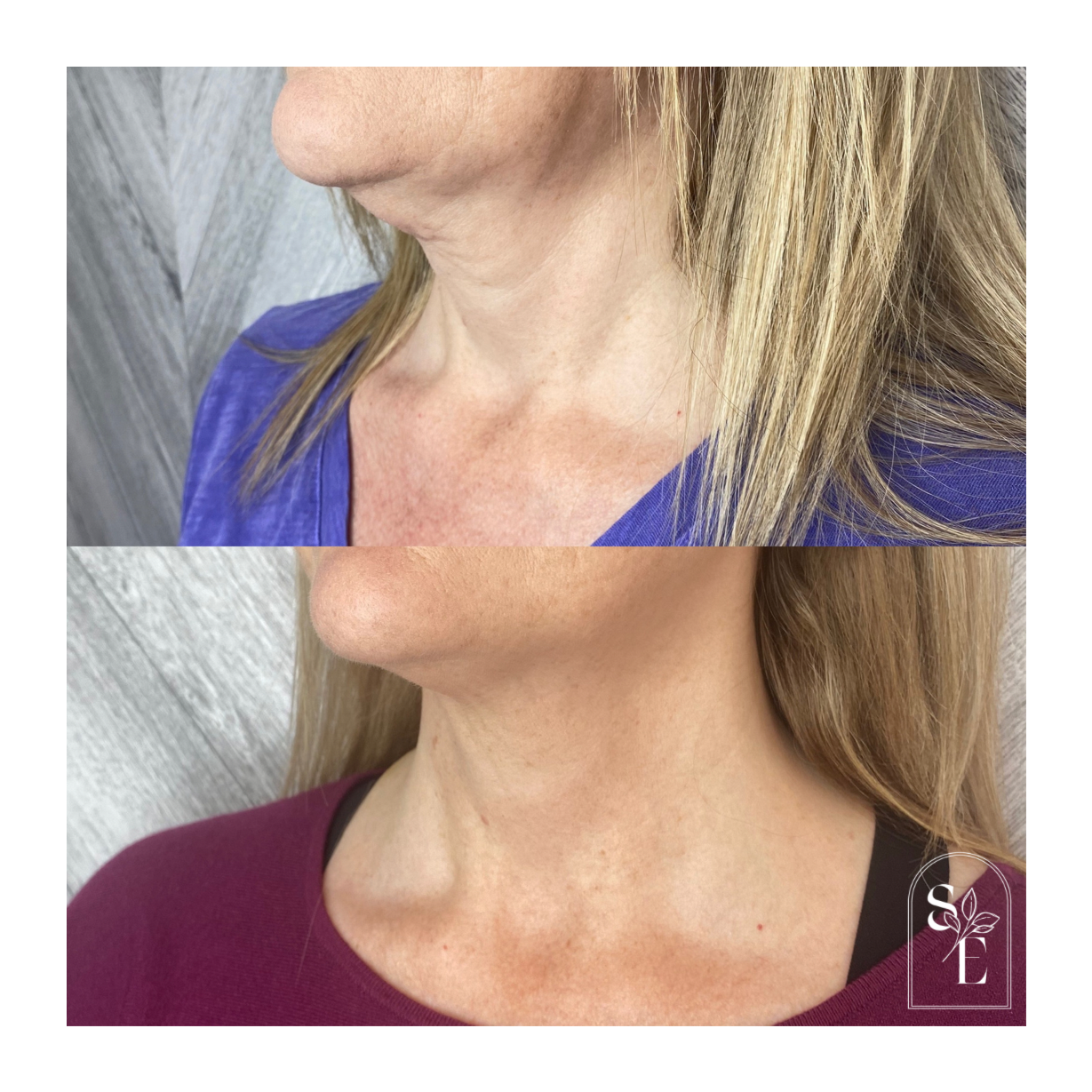 Sculptra Neck Rejuvenation