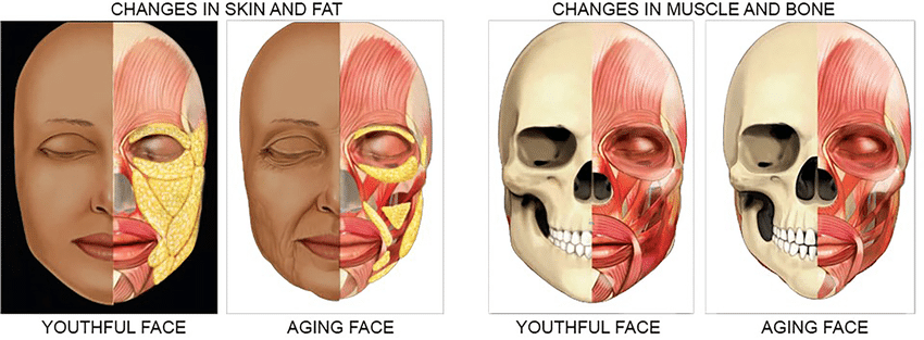 diagram showing the changes of skin, fat, muscle, and bone between a youthful face and an aging one
