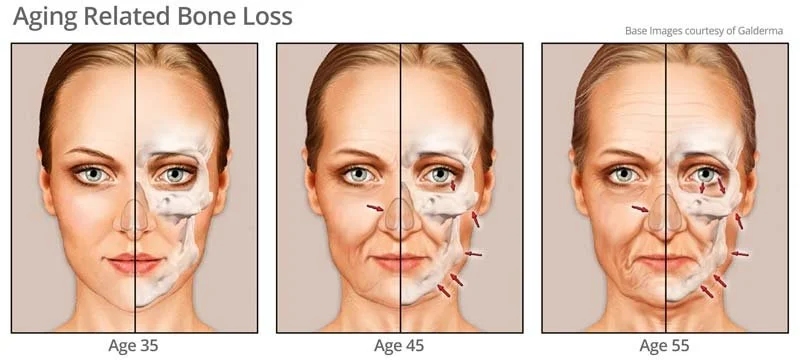 aging related bone loss diagram