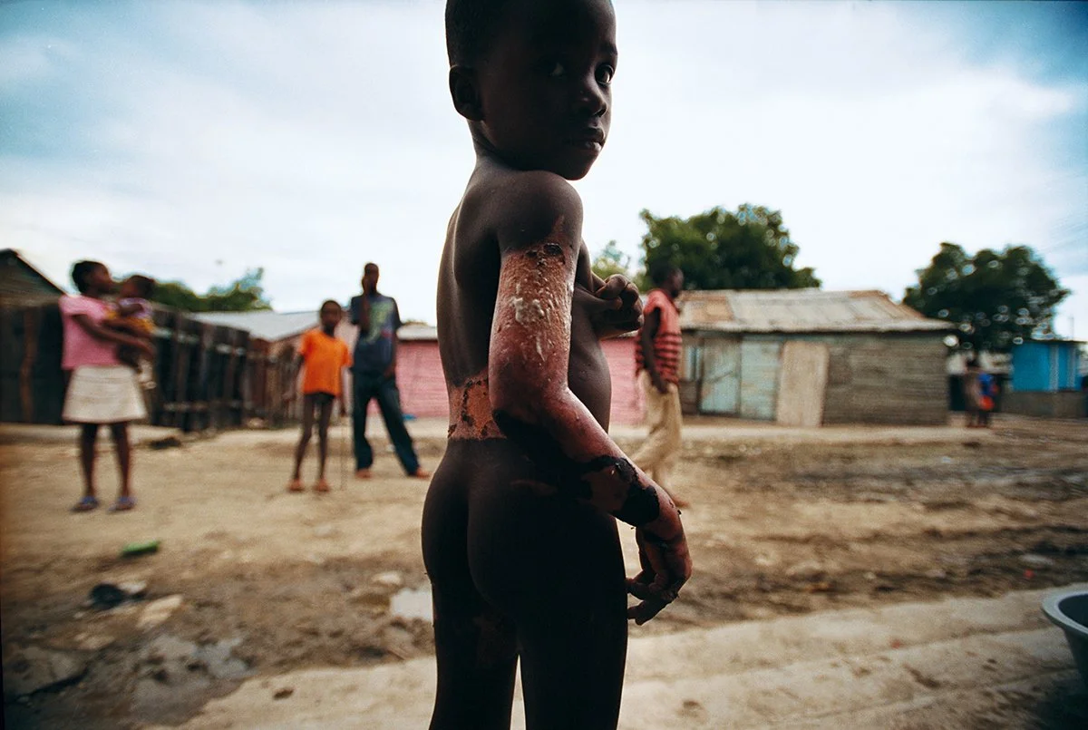 A young boy with severe burns on his arm and torso in a run-down neighborhood.