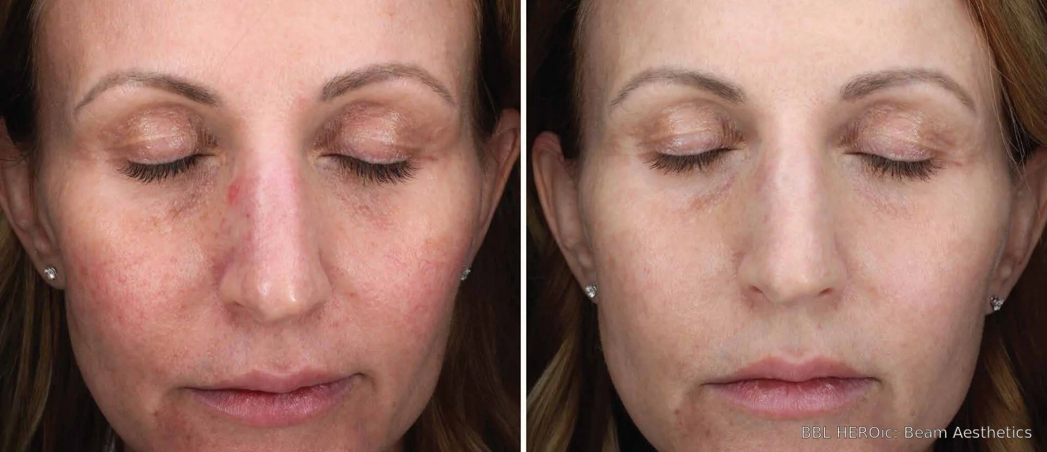 Before-and-after BBL HEROic facial photos showing reduced redness and more even-looking skin tone three months after three treatments.