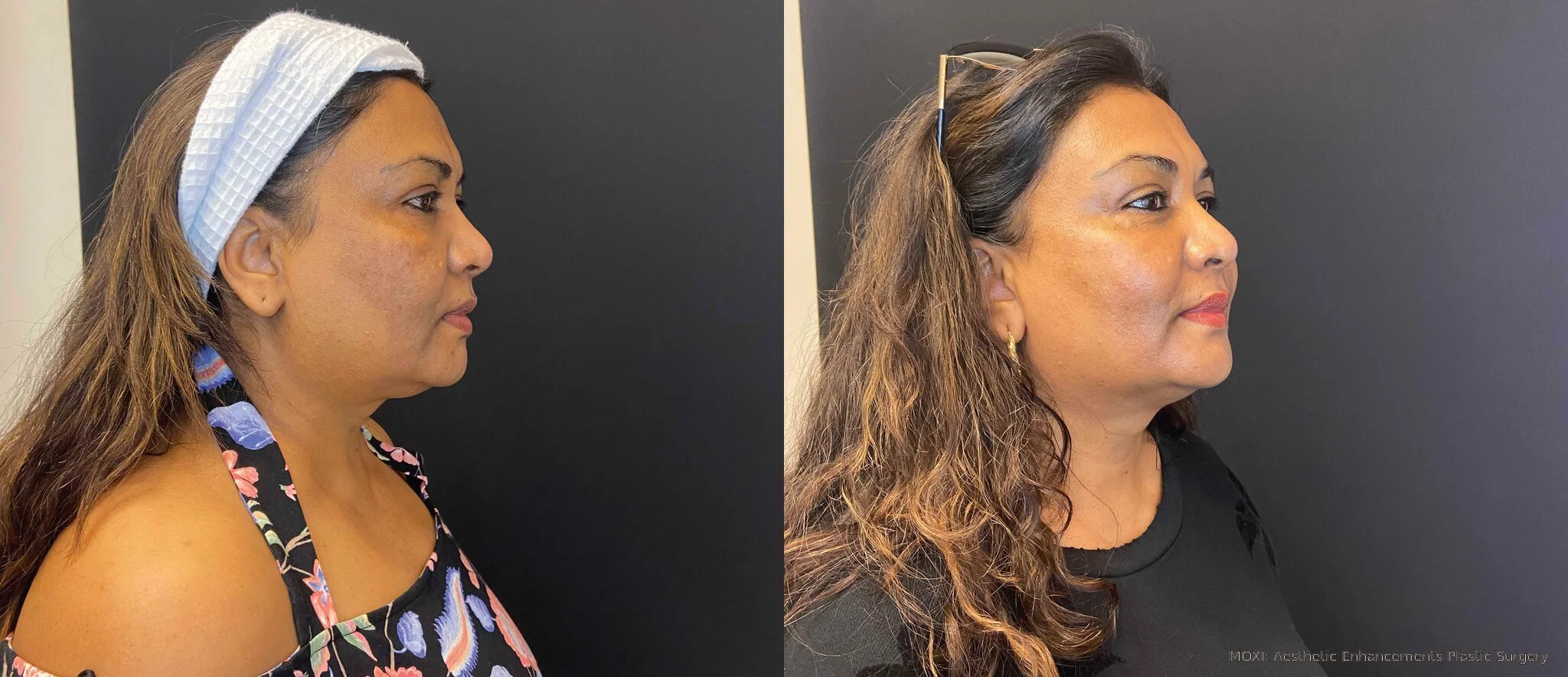 Before-and-after MOXI cheek photos showing more even-looking skin tone and reduced visible discoloration one month after one treatment.