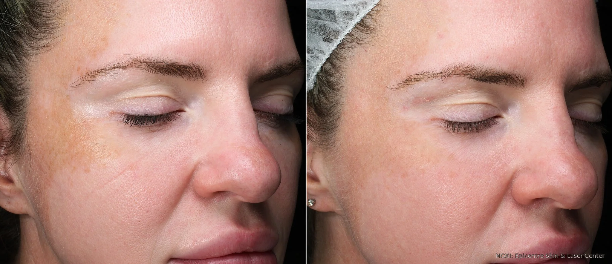 Before-and-after MOXI facial photos showing reduced redness and smoother-looking texture six weeks after one treatment.