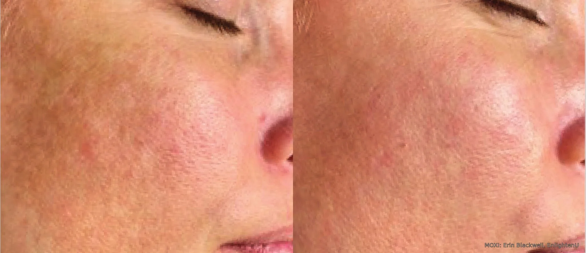 Before-and-after MOXI cheek photos showing reduced redness and more even-looking pigmentation after one treatment.