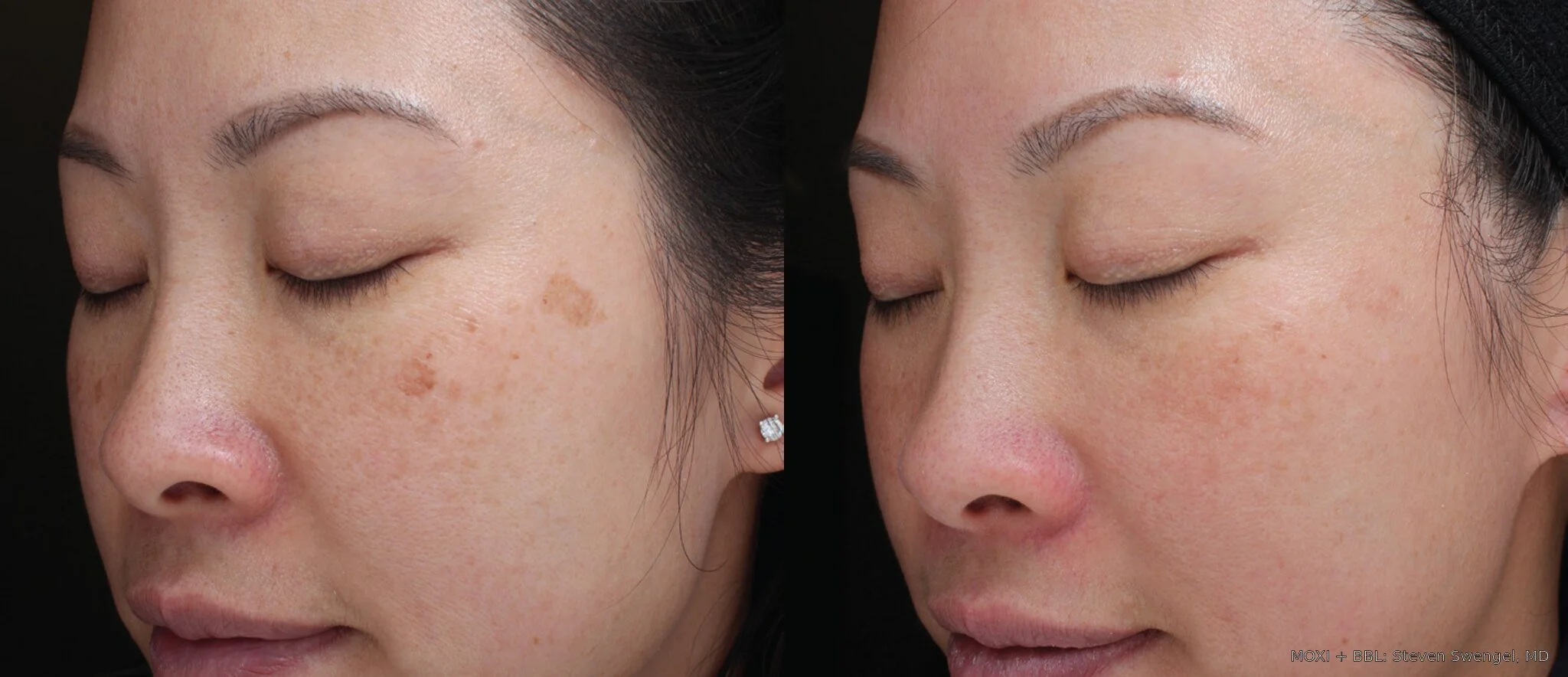 Before-and-after MOXI and BBL cheek photos showing reduced brown spots and more even-looking skin tone after five treatments.