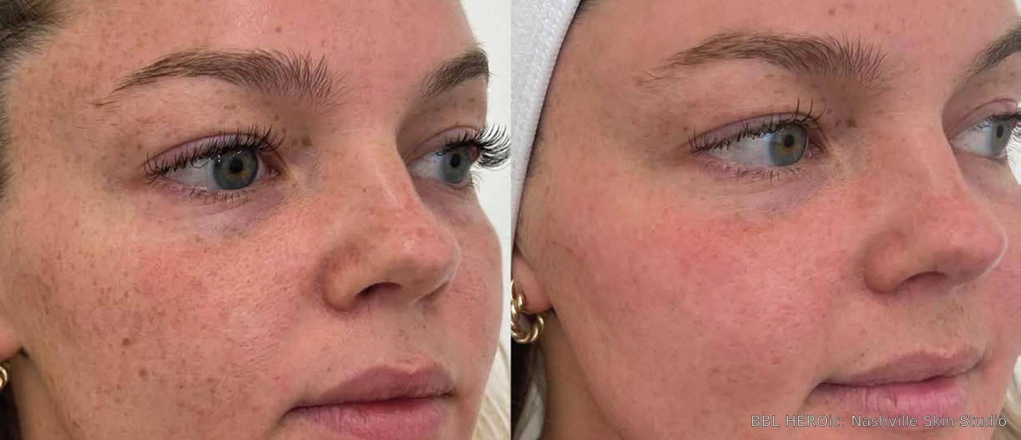 Before-and-after BBL HEROic right-profile photos showing reduced freckles and brown spots one month after one treatment.