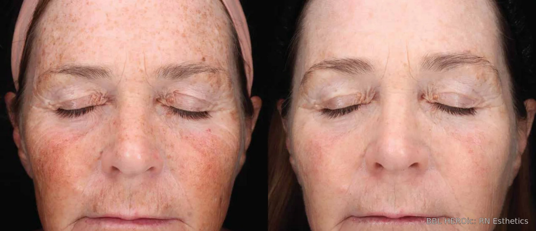 Before-and-after BBL HEROic full-face photos showing reduced brown spots and more even-looking skin tone four months after three treatments.