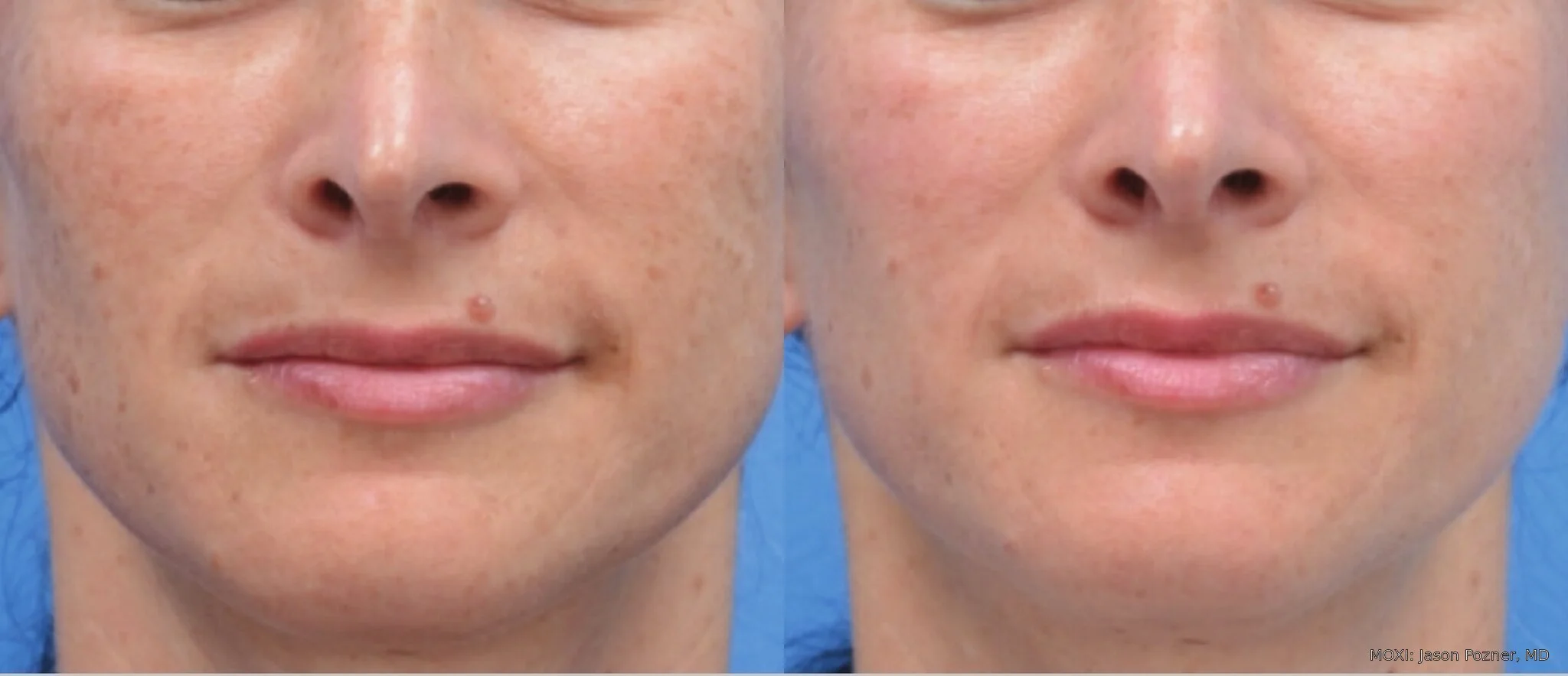 Before-and-after MOXI cheek photos showing smoother-looking texture and softened fine lines one month after one treatment.