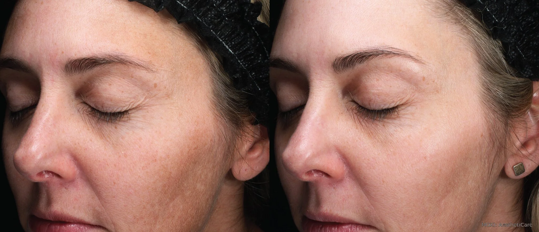 Before-and-after MOXI cheek photos showing smoother-looking texture and reduced visible pigmentation after three treatments.