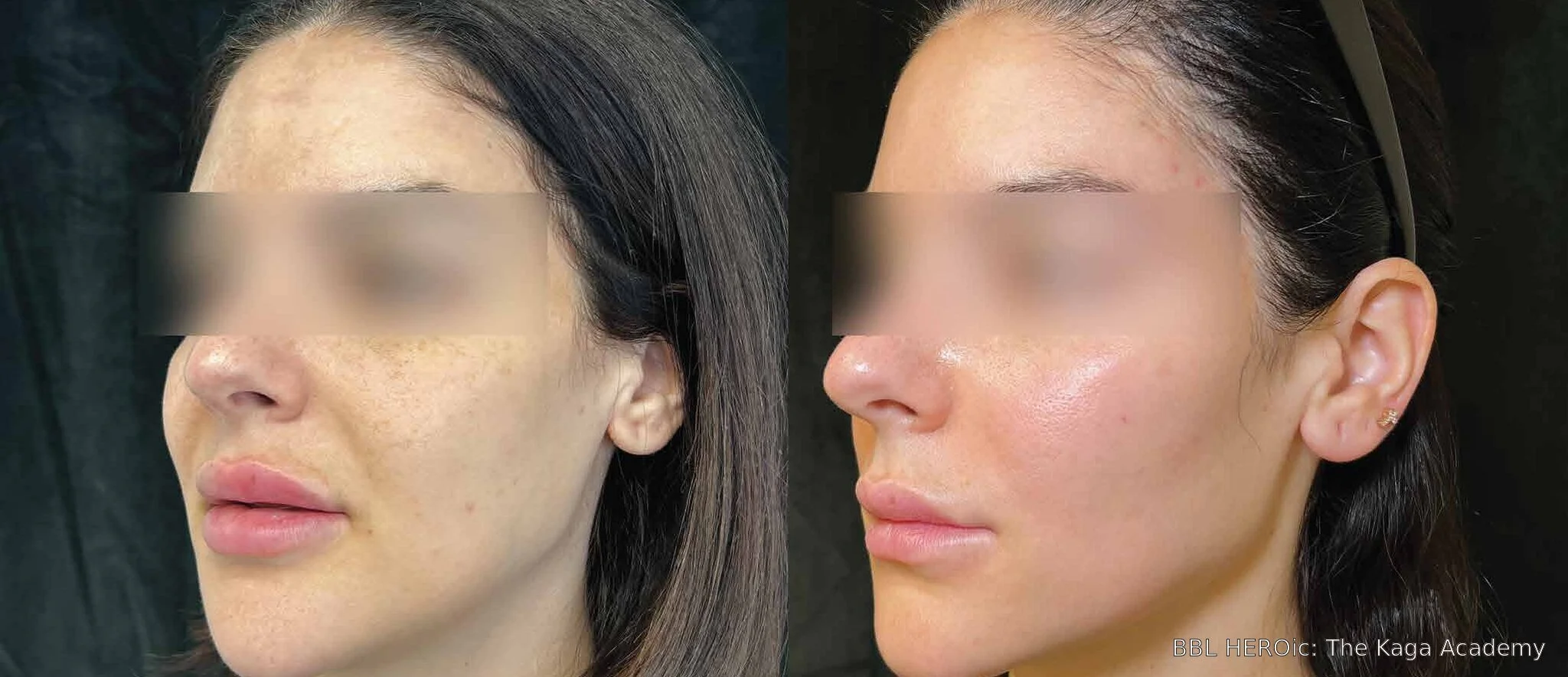 Before-and-after BBL HEROic facial photos showing reduced pigmentation and a more even-looking complexion two months after one treatment.