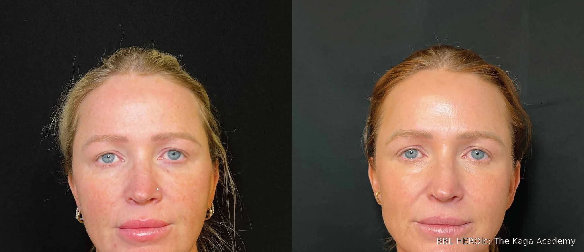Before-and-after BBL HEROic full-face photos showing reduced visible sun damage and more even-looking tone 11 months after one treatment.