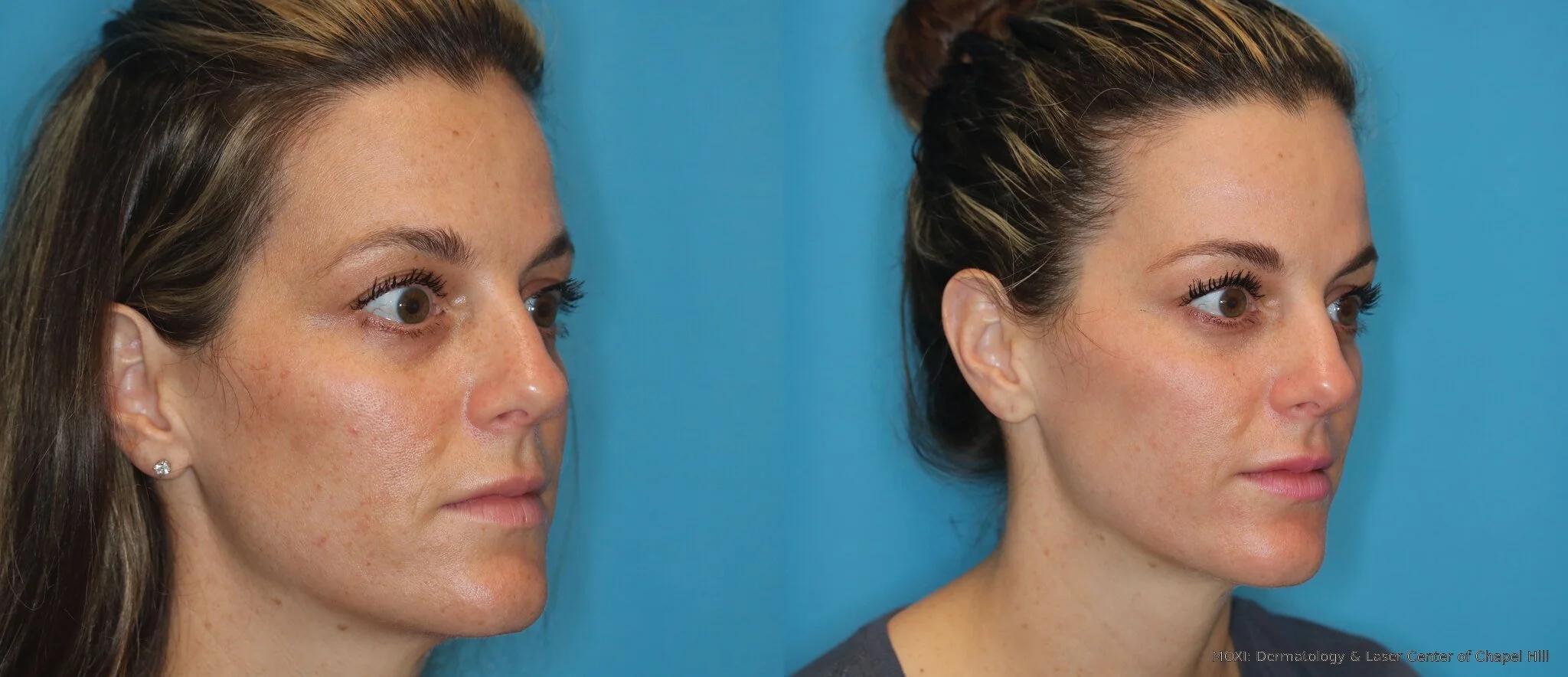 Before-and-after MOXI left-cheek photos showing reduced visible pigmentation and more even-looking skin tone after one treatment.