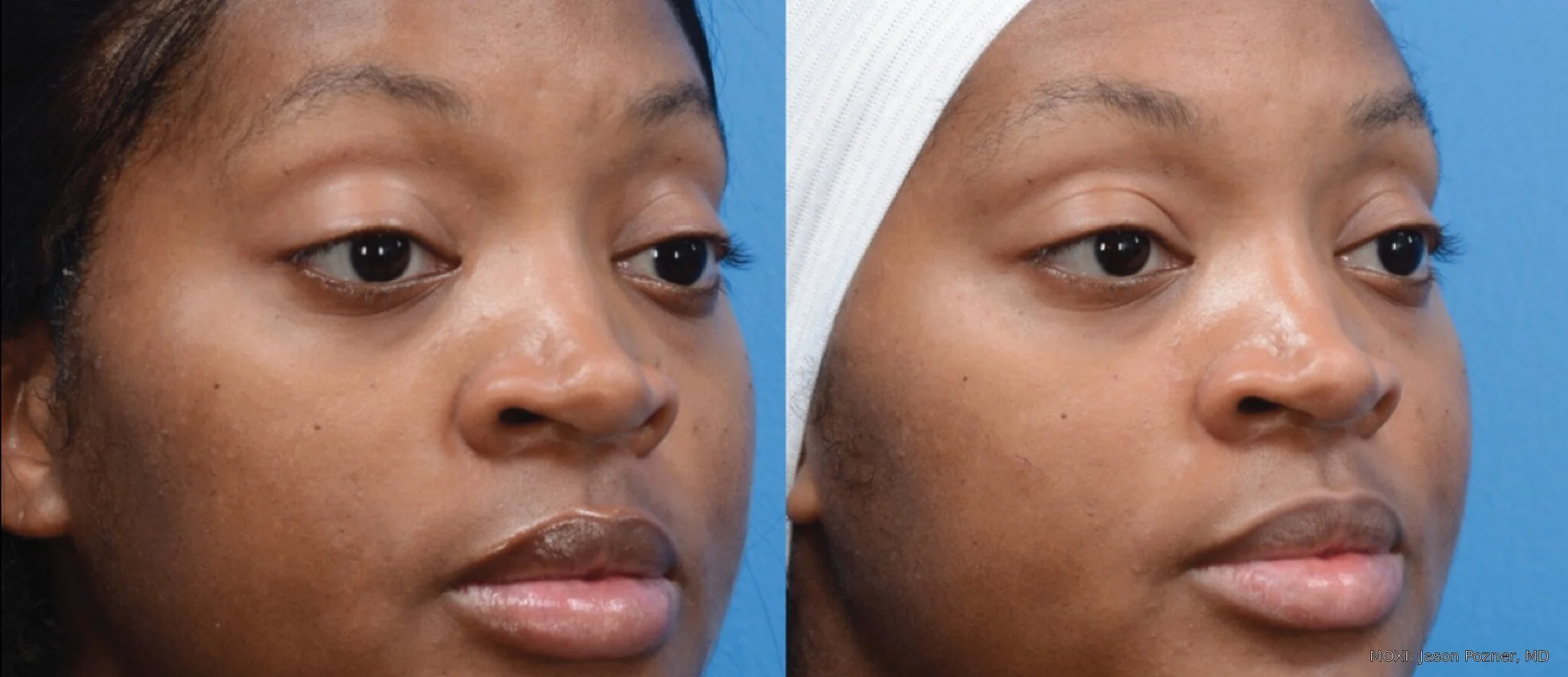 Before-and-after MOXI facial photos showing smoother-looking cheek texture and more even-looking skin tone after one treatment.