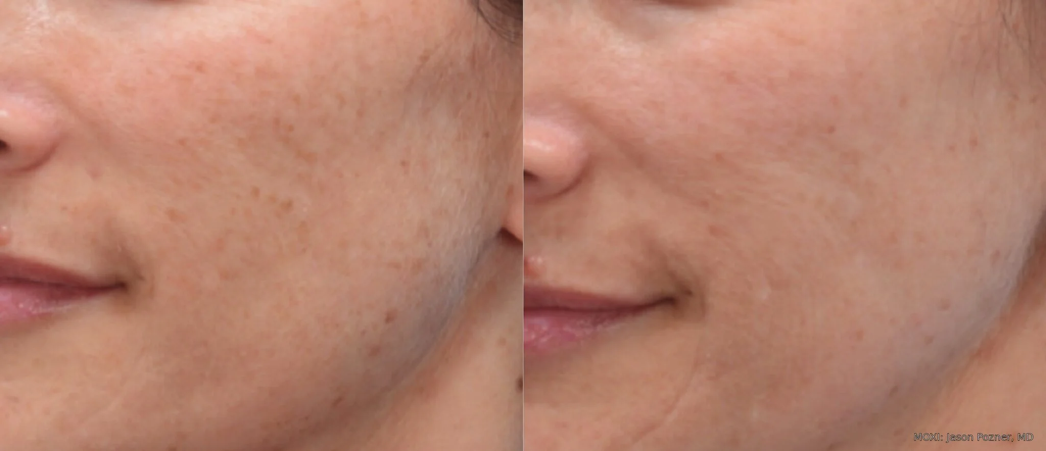 Before-and-after MOXI facial photos showing smoother-looking cheek texture and more even-looking skin tone after one treatment.