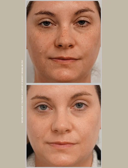 Before-and-after BBL HEROic photos showing reduced facial brown spots, freckles, and uneven pigmentation.