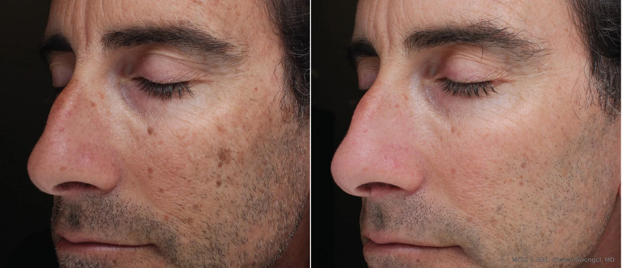 Before-and-after MOXI and BBL cheek photos showing reduced redness and more even-looking pigmentation after three treatments.