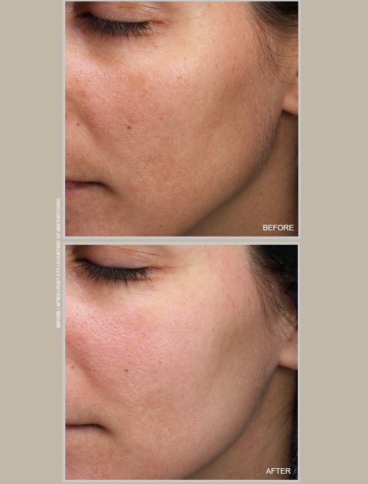 Before-and-after MOXI laser photos showing smoother-looking cheek texture and a more even skin tone.