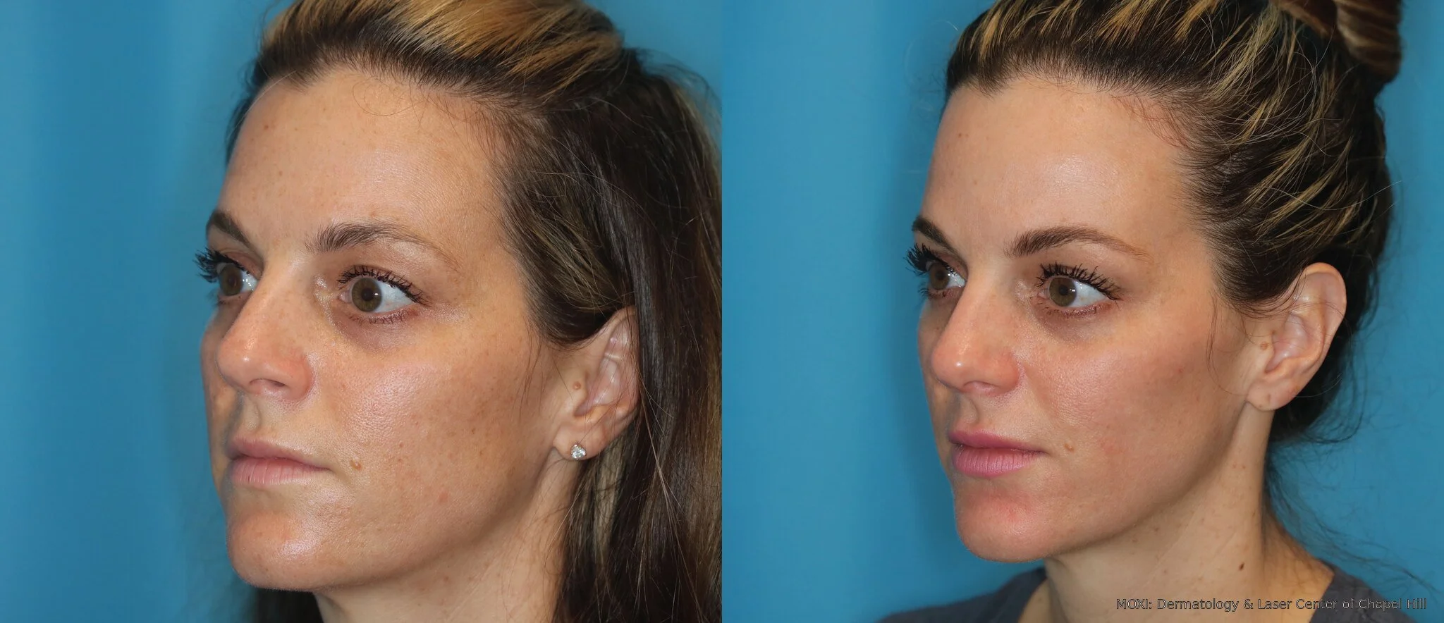 Before-and-after MOXI right-cheek photos showing reduced visible pigmentation and more even-looking skin tone after one treatment.