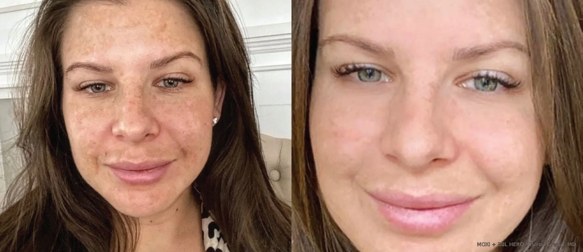 Before-and-after MOXI and BBL HERO full-face photos showing more even-looking skin tone after one combined treatment.