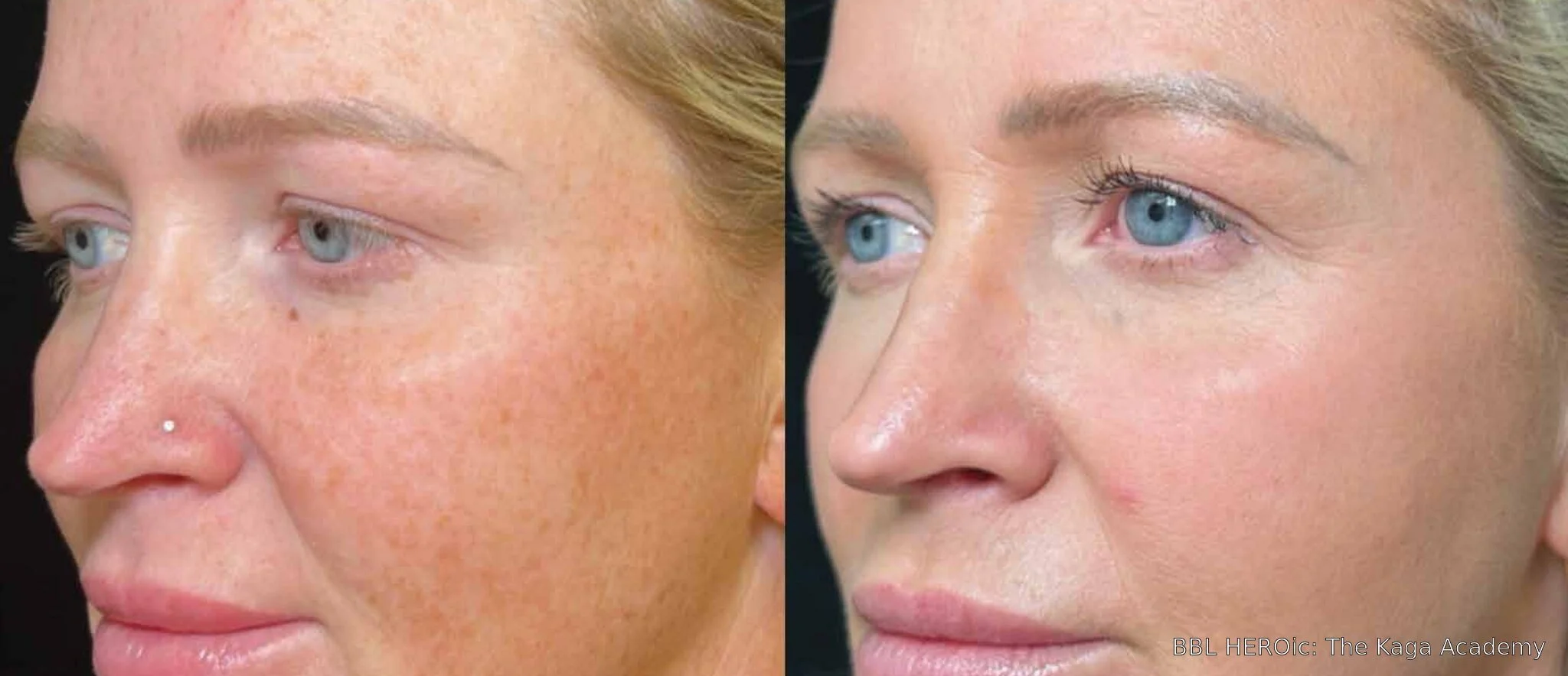 Before-and-after BBL HEROic side-view photos showing reduced facial pigmentation and more even-looking tone 11 months after one treatment.