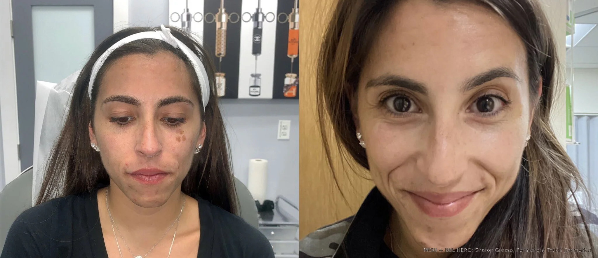 Before-and-after BBL HERO and MOXI full-face photos showing reduced visible pigmentation after one combined treatment.