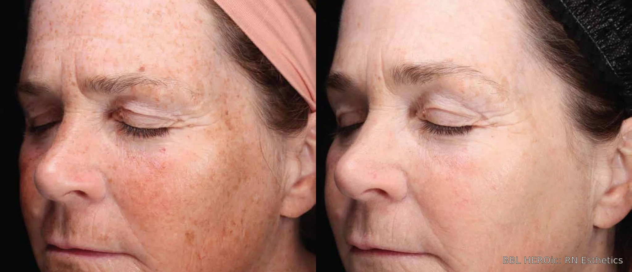 bbl-heroic-before-after-left-profile.jpg