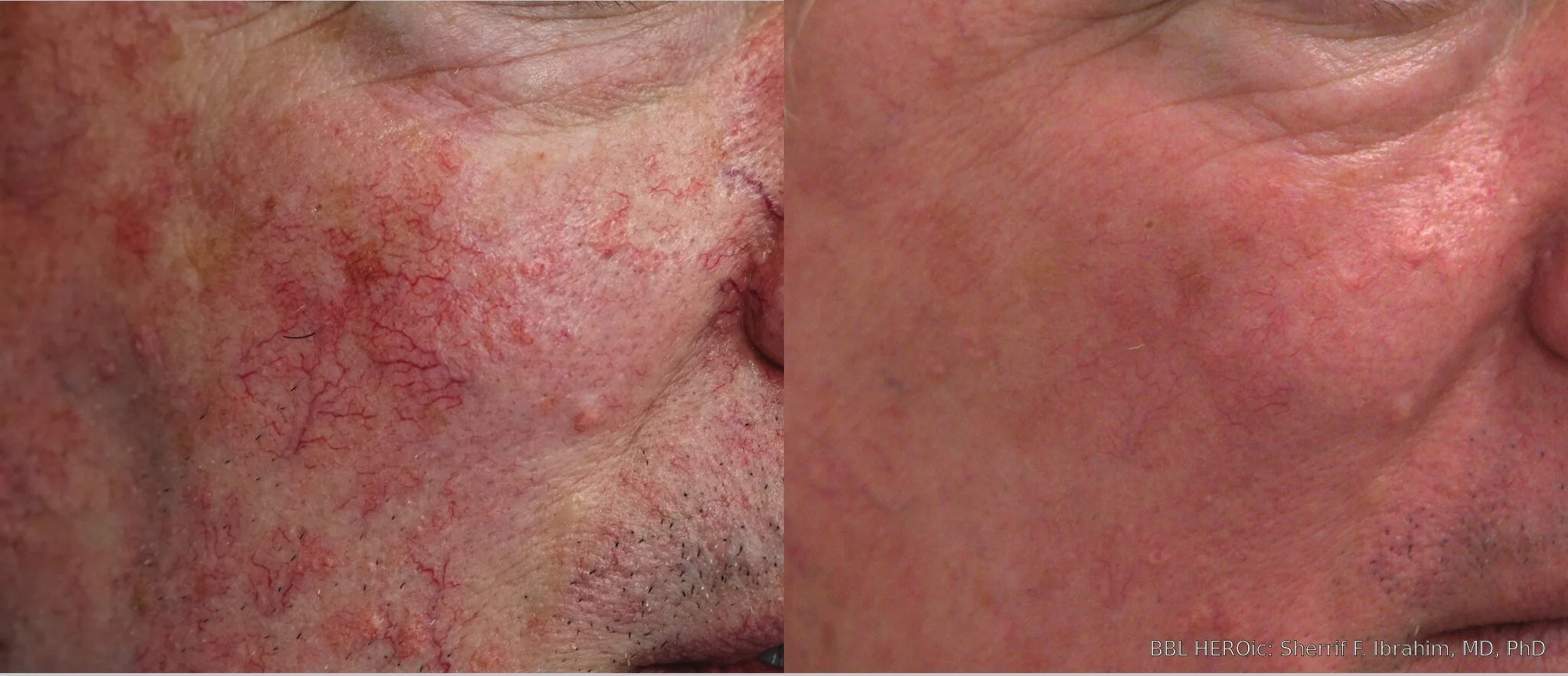 Before-and-after BBL HEROic photos showing fewer visible facial vessels and reduced cheek redness after two treatments.