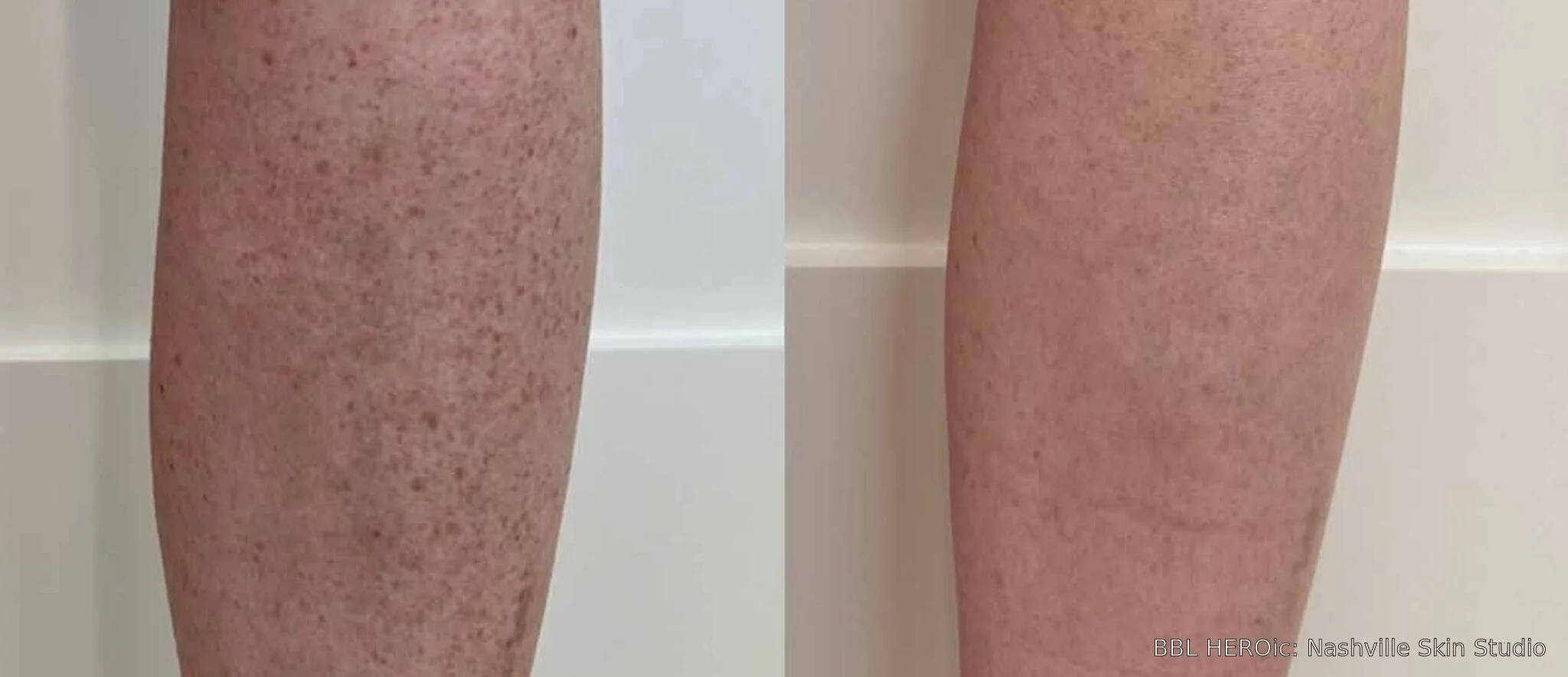 Before-and-after BBL HEROic photos showing reduced brown spots and uneven pigmentation on the lower leg two months after one treatment.
