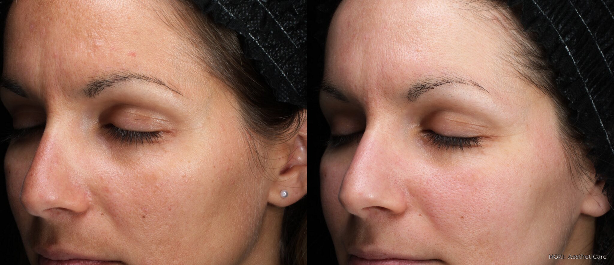 Before-and-after MOXI cheek photos showing smoother-looking texture and more even-looking skin tone after three treatments.