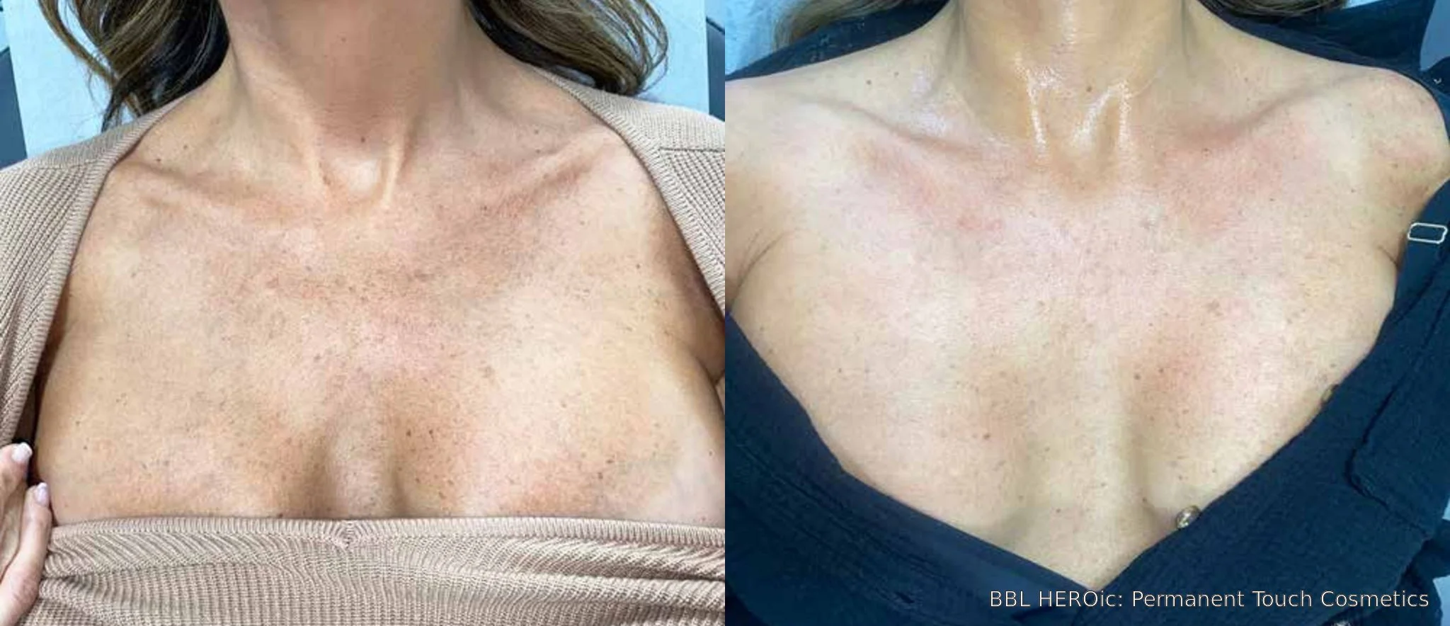 bbl-heroic-before-after-chest.jpg