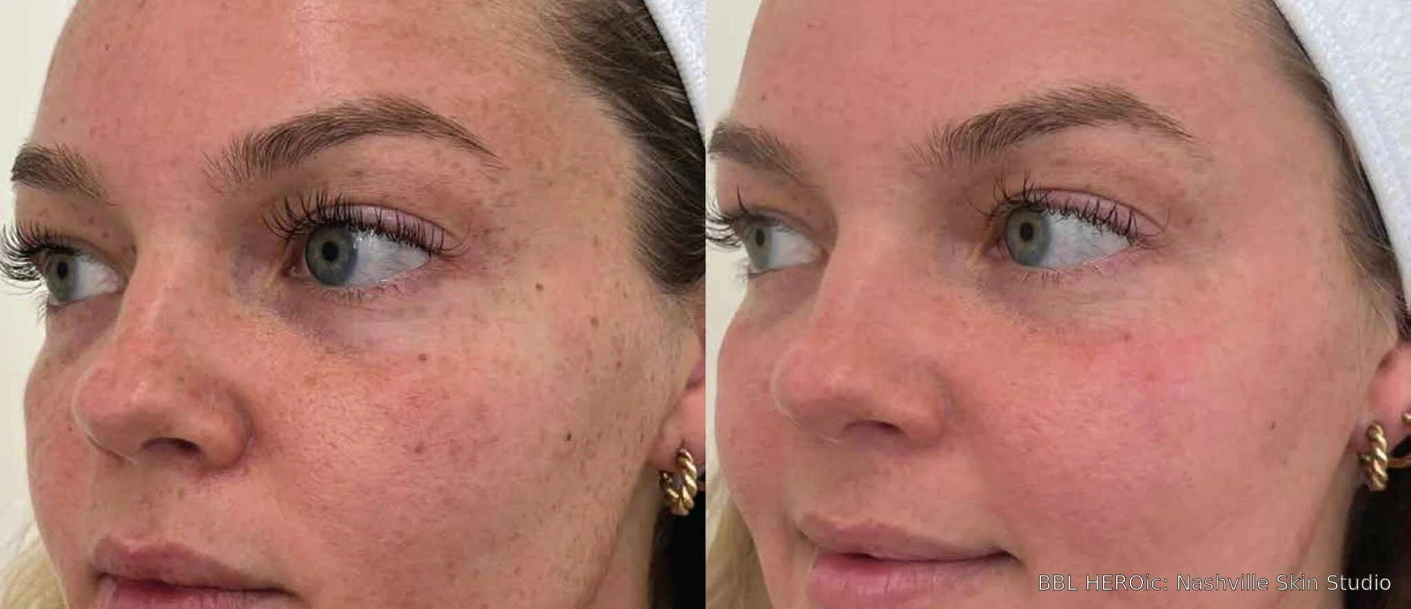 Before-and-after BBL HEROic left-profile photos showing reduced freckles and brown spots one month after one treatment.