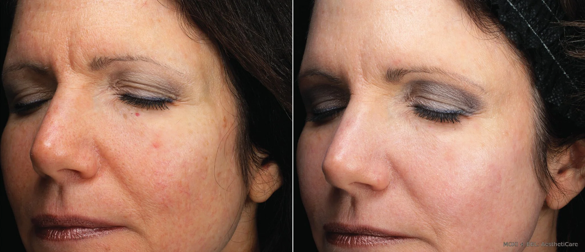 Before-and-after MOXI lower-face photos showing smoother-looking texture and more even-looking skin tone one month after one treatment.