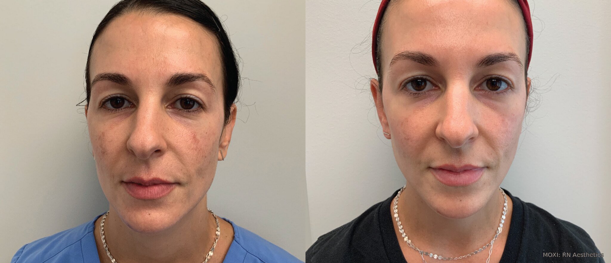 Before-and-after MOXI photos showing smoother-looking texture around the mouth one week after one treatment.