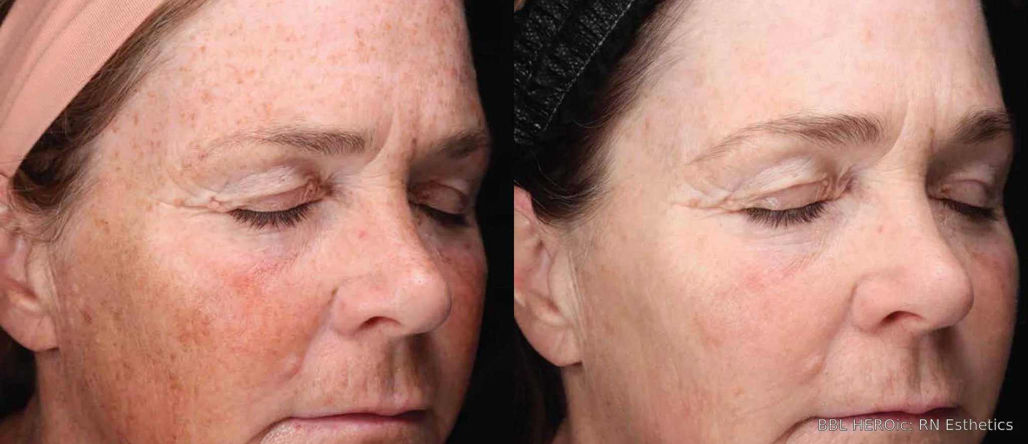 bbl-heroic-before-after-right-profile.jpg