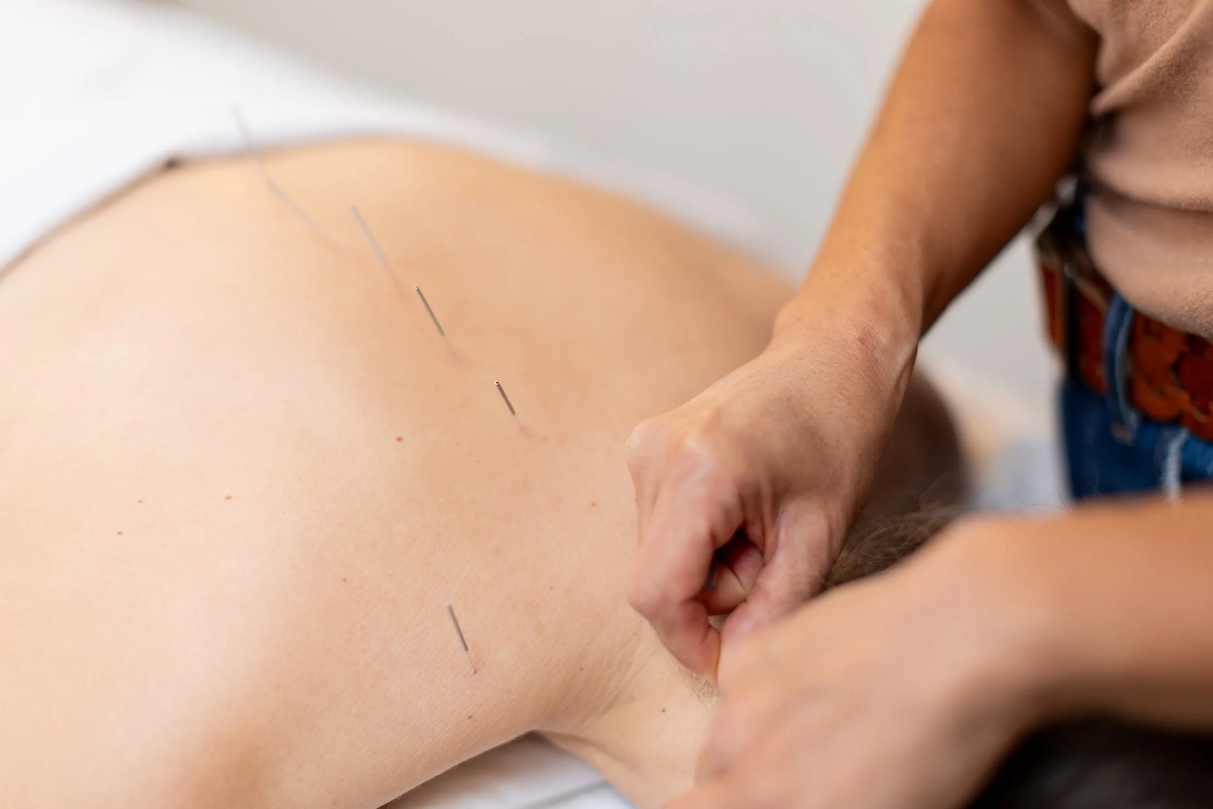Michelle Kuroda, LAc, acupuncture, dry needling, and energy healing in San Francisco, CA and Kailua-Kona, HI: Person receiving acupuncture treatment on the back with needles.