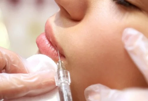 lip filler injection