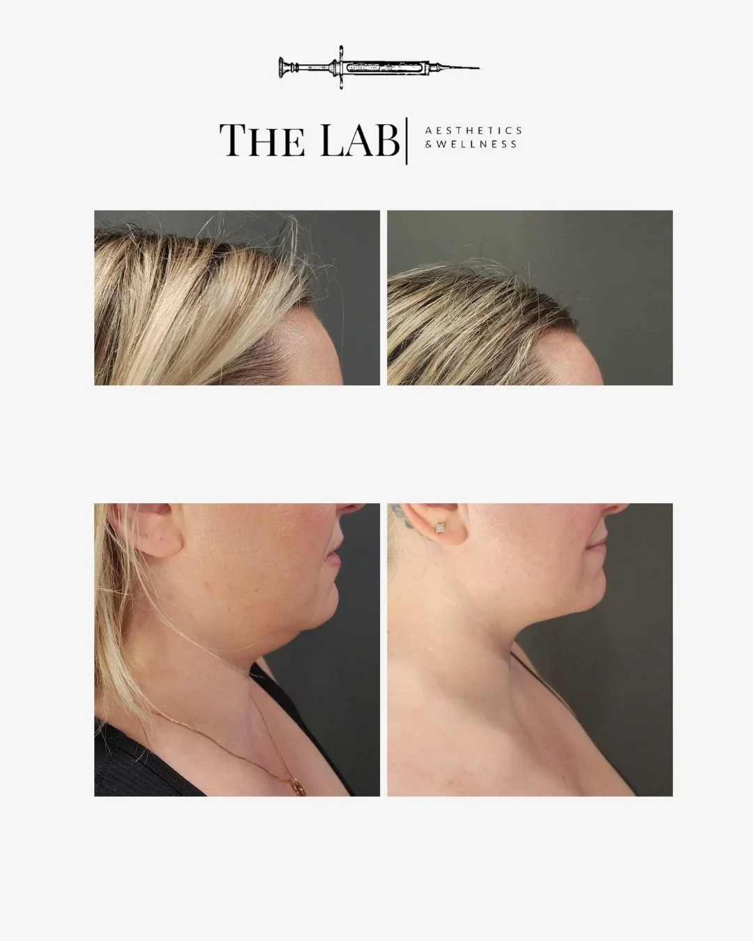 Before and after photos of cosmetic procedures showing hairline and facial profile improvements.