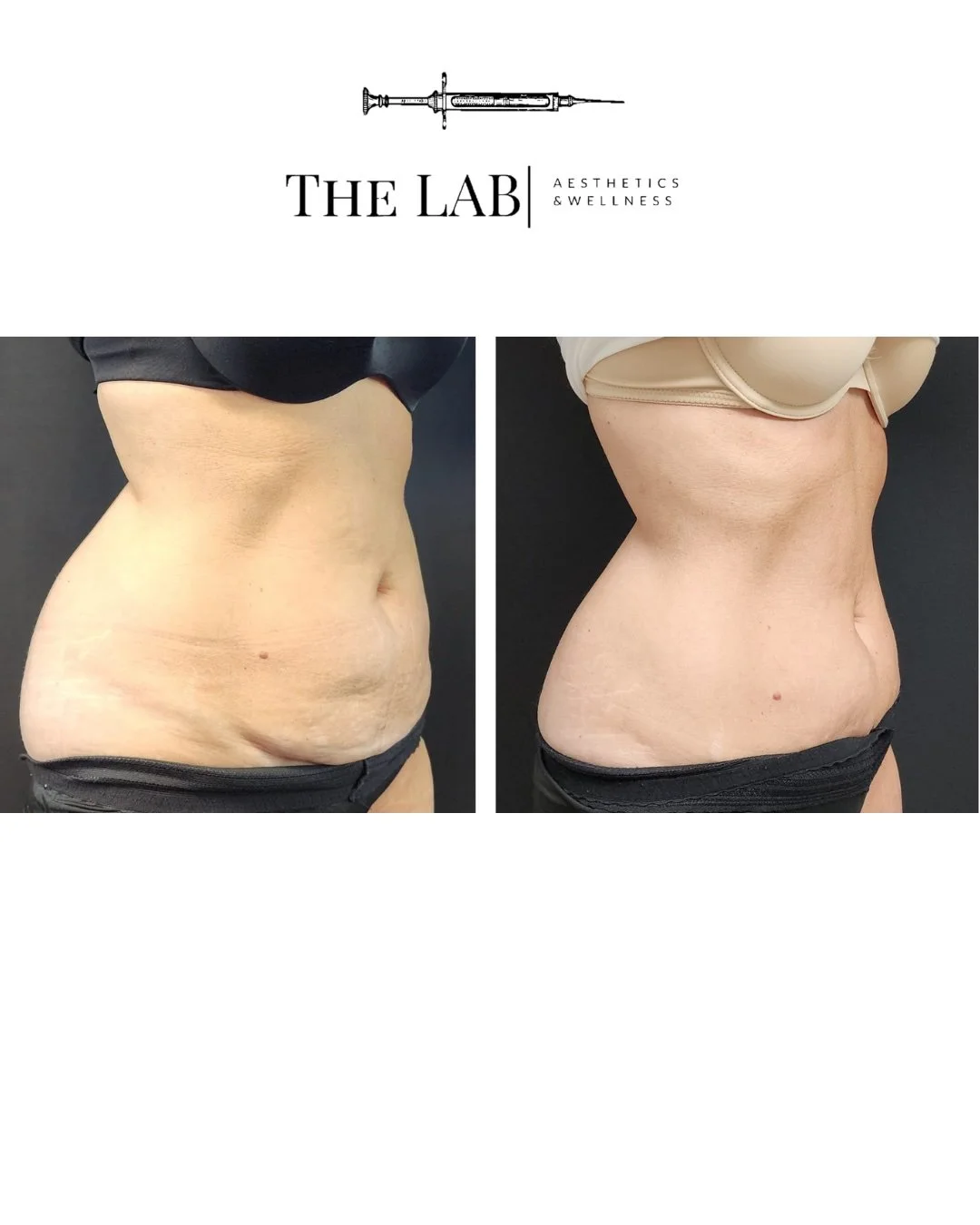 Before and after images of a woman's abdomen showing results of a cosmetic treatment, with the 'before' on the left and 'after' on the right.